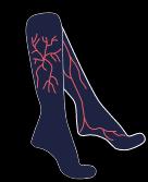 arañas vasculares o varices en las piernas