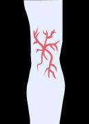 arañas vasculares reticulares en la pierna